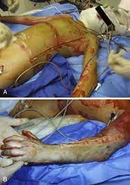 Escharotomy is surgical incision through the eschar to release the constriction, thereby restoring distal circulation and allowing for adequate ventilation. The Escharotomy Em Curious