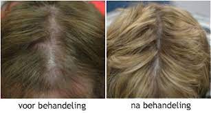 Dit middel kan bij lokale toepassing het haarverlies stabiliseren en de haargroei met. Haaruitval Bij Vrouwen Intermedica Kliniek