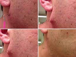 Use a rough washcloth and move in circular motions to try to tease the hair out of the skin. Is This The Longest Ingrown Hair In History Man Films Himself Removing Pus Covered Black Strand Daily Record