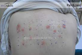 La durata di questa alimentazione varia in relazione al singolo paziente. Allergia Al Lattice Sintomi Diagnosi Trattamento Myskin Dermatologi Online