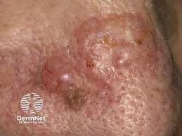 Image result for skin cancer on nose pimple