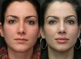 Lips, nasolabial folds (from nose to corner of mouth), marionette lines (corner of mouth to chin). Juvederm Juvederm Voluma Facial Filler Boston Ma