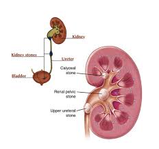 Kidney Stone Treatment Services In Vivek Khand Lucknow Id 9015503612