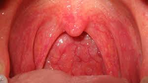 If you feel that your throat is closing in you should be examin. Cobblestone Throat Pictures Cancer Risk Other Causes Treatment