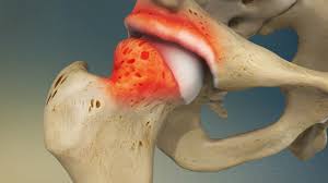 Der kostenlose service von google übersetzt in sekundenschnelle wörter, sätze und webseiten zwischen deutsch und über 100 anderen sprachen. Hip Impingement Johns Hopkins Medicine