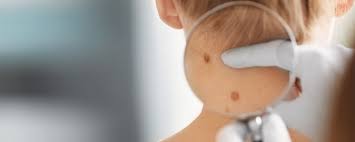 But the fact that skin cancer is much more common among poorly pigmented individuals and that skin color is inherited does support the. Skin Cancer Diagnosis Treatment Dr Kara Heelan