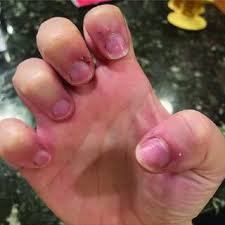 Image result for Onychotillomania feet