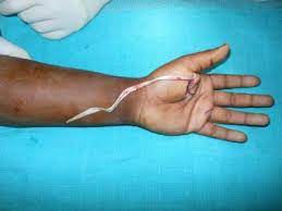 Consequently, this specific lesion was named after mannerfelt. Acute Traumatic Musculotendinous Avulsion Of The Flexor Pollicis Longus Tendon Treated With Primary Flexor Digitorum Superficialis Transfer A Novel Technique Of Management