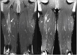 In terms of hamstring injury rate, yeung et al. Hamstring Injury In Sport