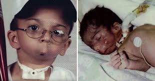 Isaiah Acosta was born without a jaw