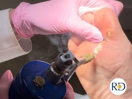 Image result for Cryotherapy