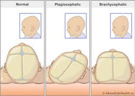 Image result for Positional Head Deformity