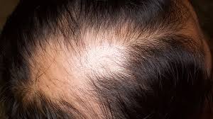 Hair loss in lupus can be caused by scarring or issues at the scalp from certain conditions or medications. How To Identify Rashes And Other Lupus Skin Symptoms Everyday Health