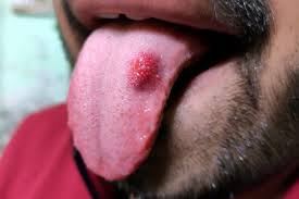 Image result for papillomavirus tongue)