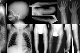 Renale osteopathie ist die bezeichnung für alle mit einer chronischen niereninsuffizienz assoziierten skelettsymptome und störungen des mineralstoffwechsels. Pedirad