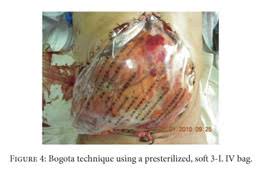 Check spelling or type a new query. Techniques For Abdominal Wall Closure After Damage Control Laparotomy From Temporary Abdominal Closure To Early Delayed Fascial Closure A Review Document Gale Academic Onefile