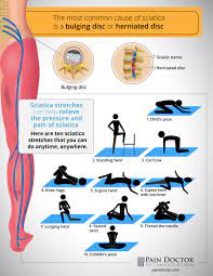 This sciatica exercise provides pain relief by literally flossing a trapped nerve through tight spaces in the back and legs. Sciatic Nerve Pain Relief