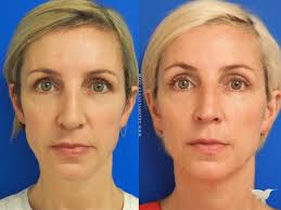 This beneficial treatment requires at least three visits to lasermed skin and vein clinic. Sculptra 101 Everything You Need To Know About The Incredible Collagen Restoring Treatment Skin By Lovely