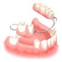 Prothèses complètes fixes sur implants. Proteza Dentara Partiala Ghid Complet Pentru Pacienti