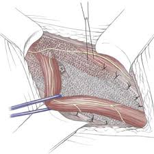 The inguinal canal is a passageway through the abdominal wall near the groin. Surgical Anatomy Of The Groin Intechopen