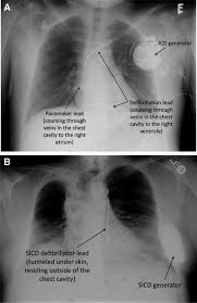 The right atrial pacemaker lead is located in the atrial appendage. Subcutaneous Implantable Cardioverter Defibrillator Circulation