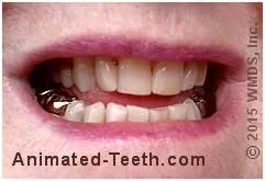 We provide the us free and free denture dentist clinic list. Types Of Crowns Porcelain Fused To Metal Ceramic Metal Gold