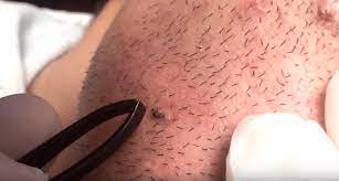 Ingrown hair is a common condition that results from hair removal. Pin On Ingrown Hair Products