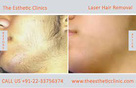 According to the american society of plastic. Laser Treatment For Face Hair Removal Off 59 Online Shopping Site For Fashion Lifestyle