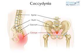 If the injury is traumatic, a bruise may be visible in this area. Tailbone Pain Aka Coccydynia