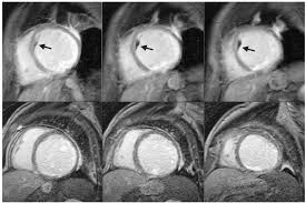 Check spelling or type a new query. Visualization Of Ventricular Thrombi With Contrast Enhanced Magnetic Resonance Imaging In Patients With Ischemic Heart Disease Circulation