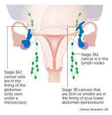 stage 3 ovarian cancer cancer research uk