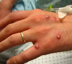 The time from exposure to onset of symptoms is around 10 days. Monkeypox Background Pathophysiology Etiology