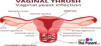 Aviacija Dabar Nuodėmė Yeast Infection During Pregnancy First Trimester Yenanchen Com