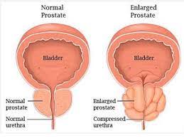 Enlarged Prostate Lower Back Pain And Frequent Urination This Is The Way Out Latest Nigeria News Nigerian Newspapers Politics