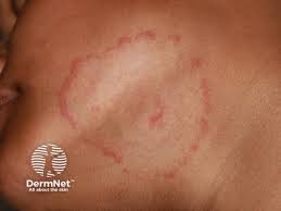 Image result for red rash face