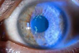 Maybe you would like to learn more about one of these? Herpes Simplex Keratitis Wills Eye Hospital