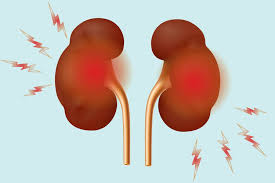 How Inflammatory Arthritis Affects The Kidneys You had surgery to remove part of one kidney or the entire kidney, the lymph nodes near it, and maybe your adrenal gland. inflammatory arthritis affects the kidneys