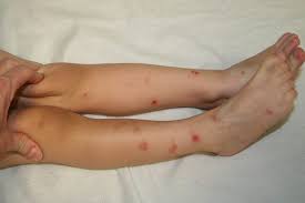 Image result for flea bites
