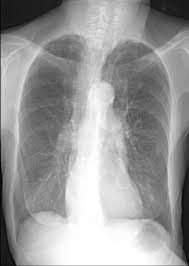 Image result for Cor Pulmonale