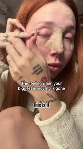 Naomi Oquendo Rhinoplasty Journey