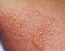 Image result for Atopic eczema atopic dermatitis
