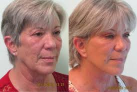 If you have long hair, tie it up in such a way that it enhances hair volume near the forehead area, giving you a younger look, while also hiding the sagging jowls. What Is The Best Treatment For Sagging Jowls Las Vegas Facelift Tlc Lift The Lanfranchi Center