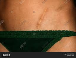 We did not find results for: Scar On Abdomen Image Photo Free Trial Bigstock