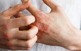 Eczema, or dermatitis as it is sometimes called, is a group of skin conditions which can affect all age groups. Best Ayurvedic Treatment For Eczema Natural Home Remedies For Eczema