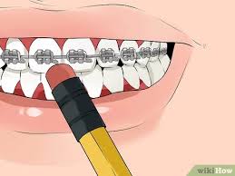 Some of the treatments include braces (wired or without wire). How To Fix A Broken Braces Wire 6 Steps With Pictures Wikihow
