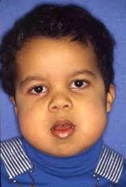 Most people with cherubism have few, if any, signs and symptoms affecting other parts of the body. The Multidisciplinary Management Of The Cherubism Patient For Function And Aesthetics Journal Of The World Federation Of Orthodontists