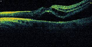 What is a retinal tear? Macula Re Attachment Following Intravitreal Ranibizumab In Rhegmatogenous Retinal Detachment Eye News