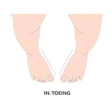 Image result for In-Toeing
