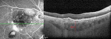 Polypoidal Choroidal Vasculopathy Ophthalmology