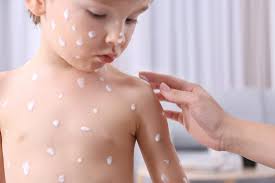 Ganz am ende der krankheit, darf das kind wieder in die einrichtung. Impfwindpocken Nach Der Impfung Bei Kindern Netpapa
